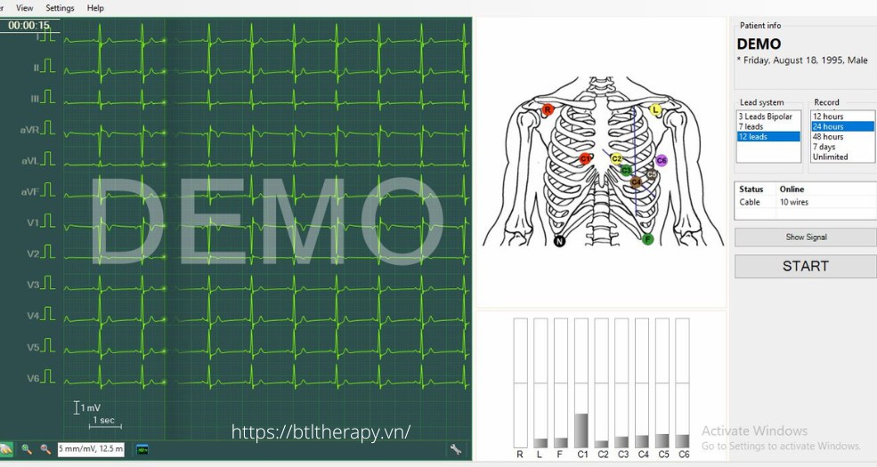 Cách đặt điện cực Holter điện tim Cách đặt điện cực Holter điện tim