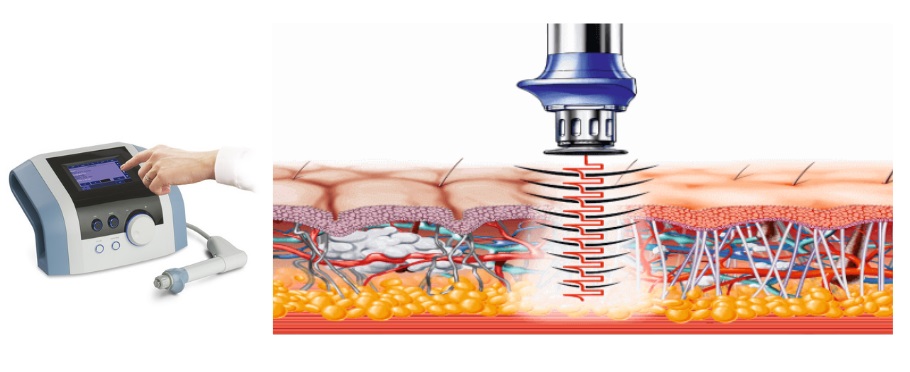 Máy Xung Kích Trị Liệu BTL 6000 Topline