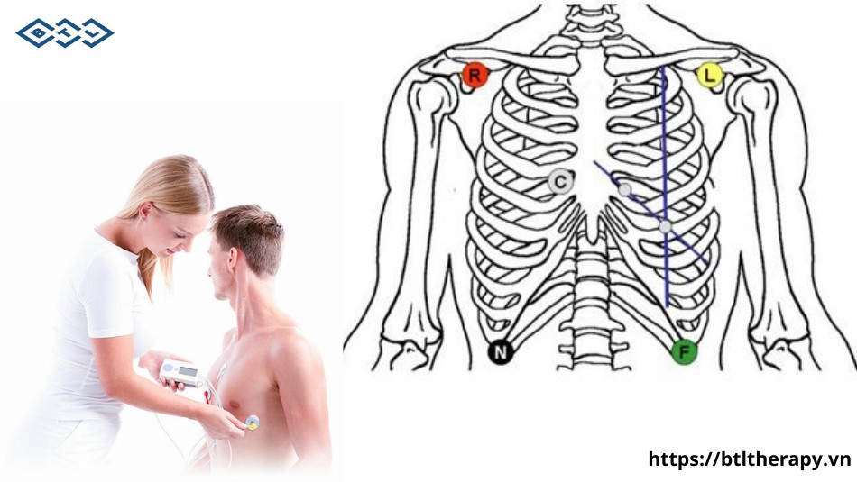 Cach lap dien cuc holter dien tim 24h