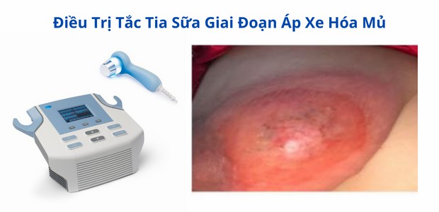 dieu tri tac tia sua bang may sieu am da tan