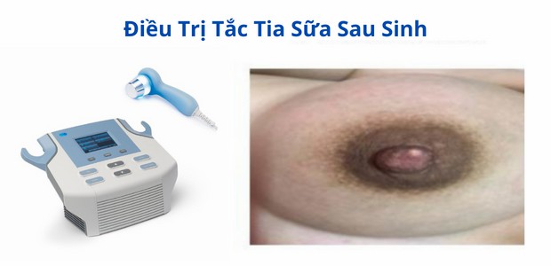 dieu tri tac tia sua bang may sieu am da tan