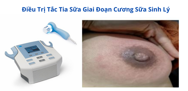 dieu tri tac tia sua bang may sieu am da tan